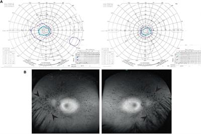 A Combined in silico, in vitro and Clinical Approach to Characterize Novel Pathogenic Missense Variants in PRPF31 in Retinitis Pigmentosa